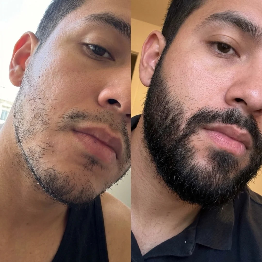 Tu barba no crece de manera uniforme, dejando huecos que afectan tu apariencia.