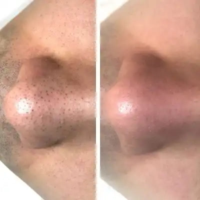¿Sufres de puntos negros y brillo excesivo?